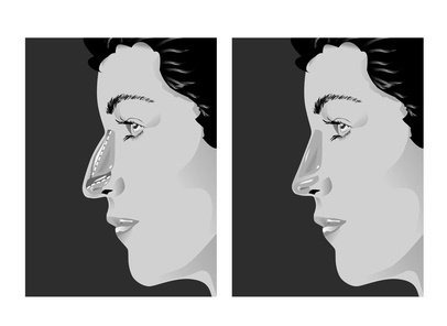Rhinoplasty-Before-and-After